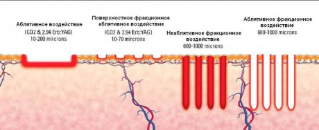 зоны омоложение лица