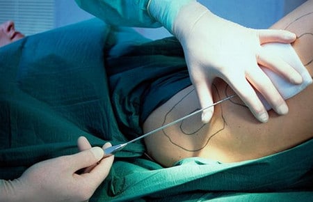 проводник лазерного луча удаление жира