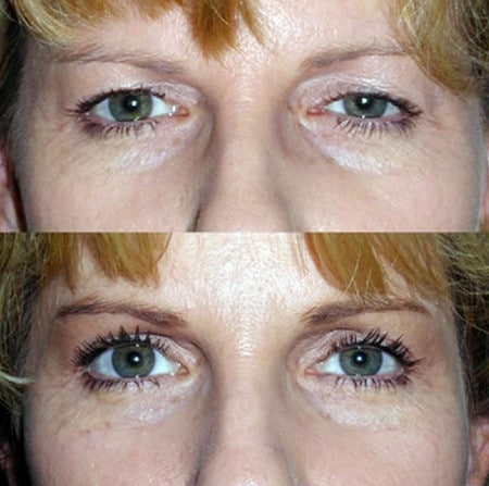 Результаты подтяжки хорошо видны до и после