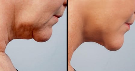 Лазерная методика