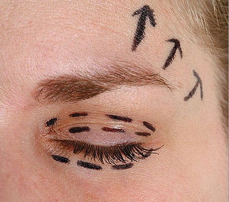 Хирург намечает маркером линии подтяжки подготовка к операции