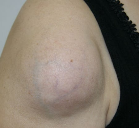 Липому стоит своевременно удалить осложнения