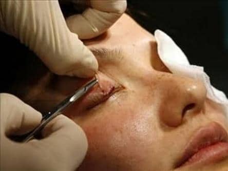 Операция выполняется под местной анестезие проведение операции