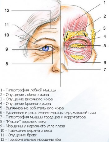 Возрастные изменения век опухание век