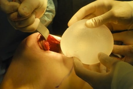 Эндопротез помещается в «карман» операция