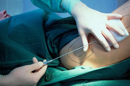 Длинная игла – проводник лазерного луча лазерная липосакция