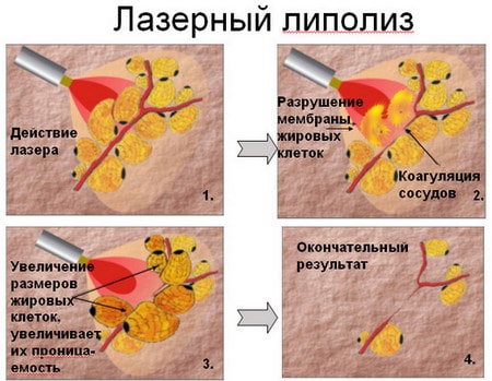 лазерный липолиз удаление жира