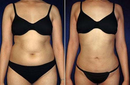 Безоперационная липосакция результаты процедуры