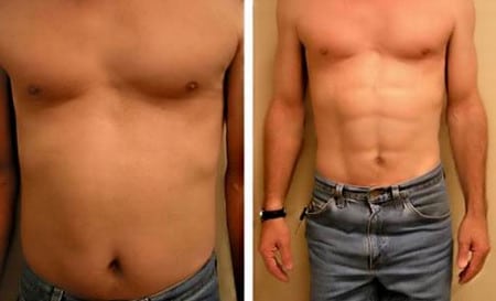 выборочная липосакция виды лепосакции