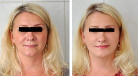 Эффект от лифтинга заметен сразу после процедуры лифтинг лица