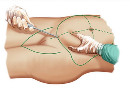 липосакция живота