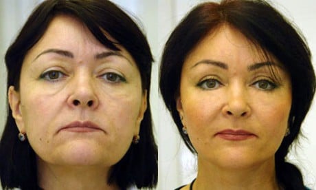 лифтинг дица