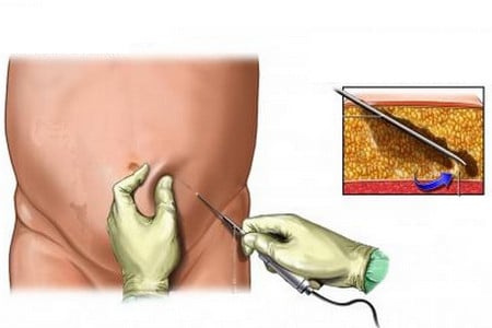 Вакуумный вариант липосакции липосакция живота