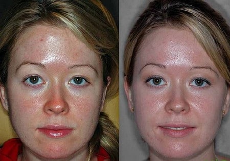 Результат процедуры удаление морщин