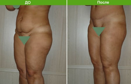 Шрам от абдоминопластики после операции