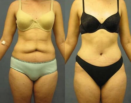 поледствия