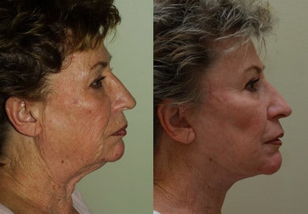 После процедуры дермабразии улучшается цвет лица до и после процедуры