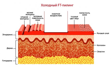 Холодный пилинг для легких дефектов кожи