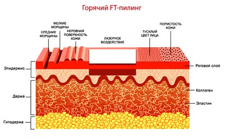 для сглаживания глубоких проблемных мест