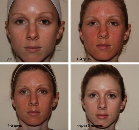 после лазерного пилинга покраснение
