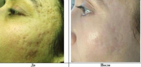 рубцы после акне или травмы становятся менее заметными убрать рубцы