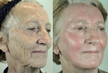 Глубинный химический пилинг безоперационная пластика