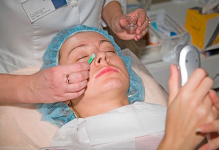 химический пилинг