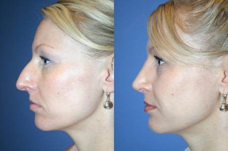 избавиться от комплексов изменить форму носа