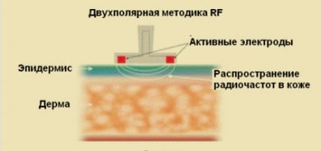 радиолифтинг