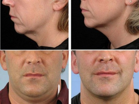 Мужчины тоже с удовольствием пользуются радиолифтингом показания к применению