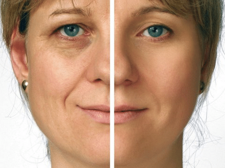 Безинъекционная мезотерапия «до» и «после» до и после