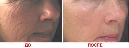 Глубокие морщины - не проблема морщины