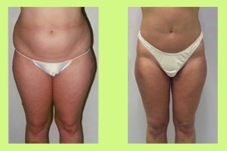 процедура воздействует на проблемные «женские» зоны эффективное удаление жира