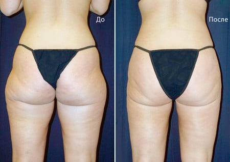 Результаты ультразвуковой липосакции до и после