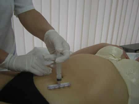 Мезотерапия – шанс подтянуть живот без боли Мезотерапия