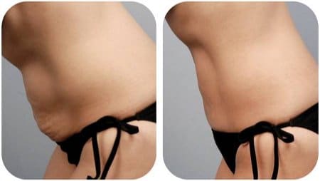 живот ДО и ПОСЛЕ процедуры нитевого лифтинга результат процедуры