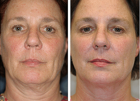 фото до и после термажа от 40 лет