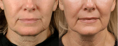 эффективность термажа термаж