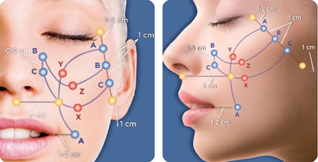 Нитевой лифтинг