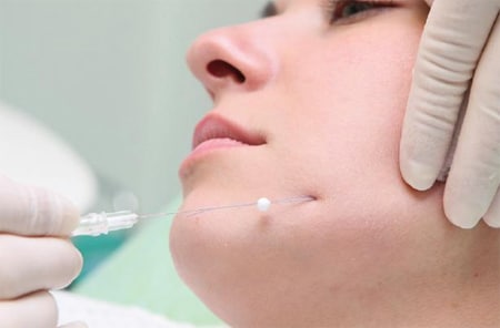 Процедура нитевого лифтинга