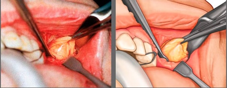 Резекция комков Биша