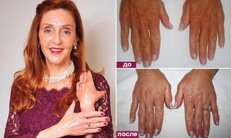 Розетт Китт до и после операции