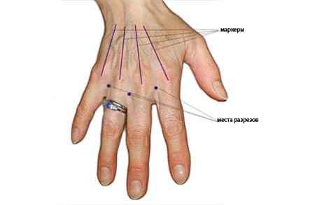 Разметка на руках перед омоложением