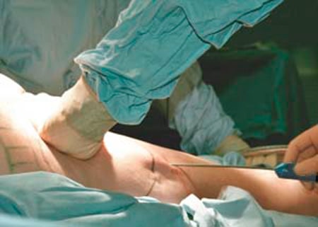 Операция по липосакции