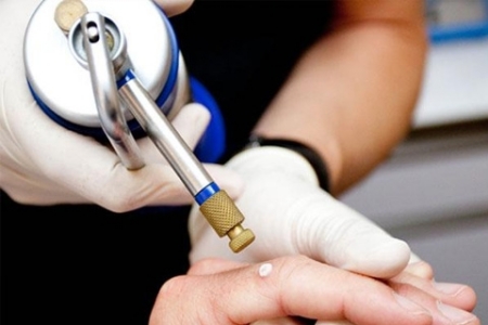 Криоудаление папилломы жидким азотом Криоудаление папилломы жидким азотом