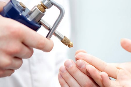 Прижигание папиллом азотом Прижигание папиллом азотом