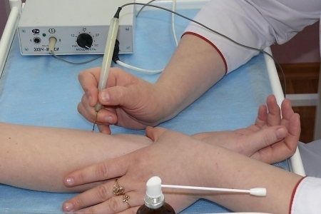 Электрокоагуляция папиллом Электрокоагуляция папиллом