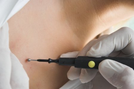 Электрокоагуляция папиллом Электрокоагуляция папиллом