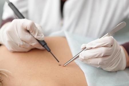 Электрокоагуляция папиллом Электрокоагуляция папиллом