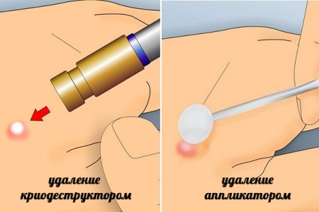 Методы удаления бородавки при помощи низких температур Методы удаления бородавки при помощи низких температур